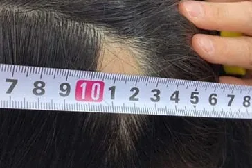 円形脱毛症の大きさ（横径）